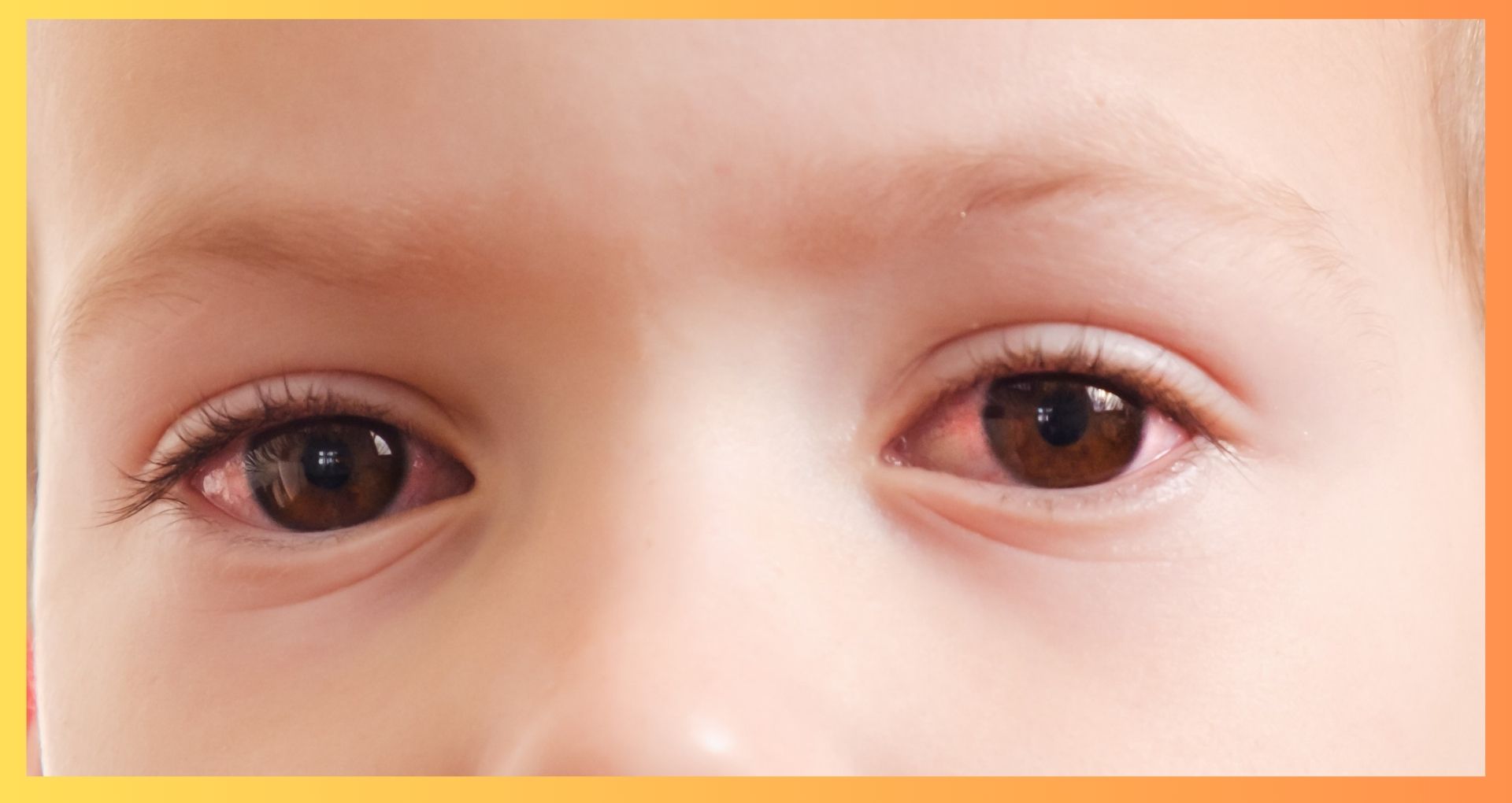 Young child with red eyes contact optometrist for appointment